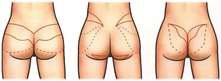 Formas de realizar lifting glúteo