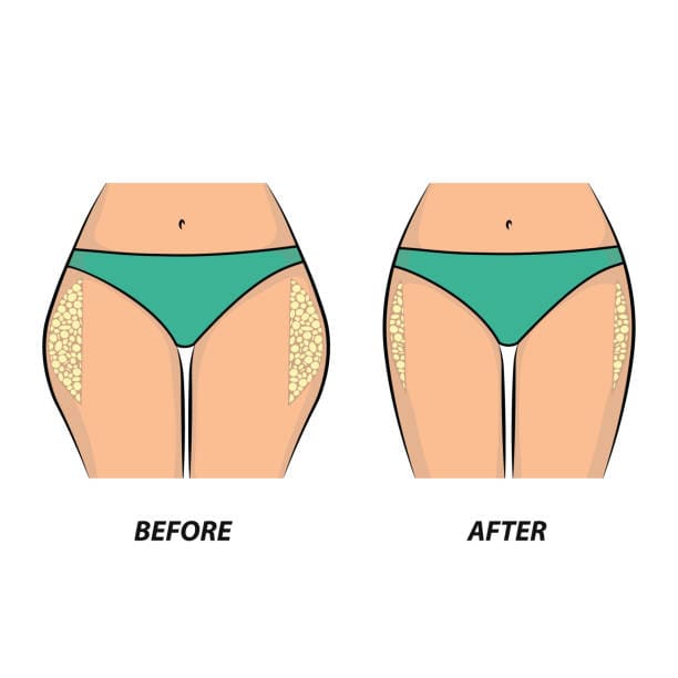 Modelado por lipoaspiracion antes después