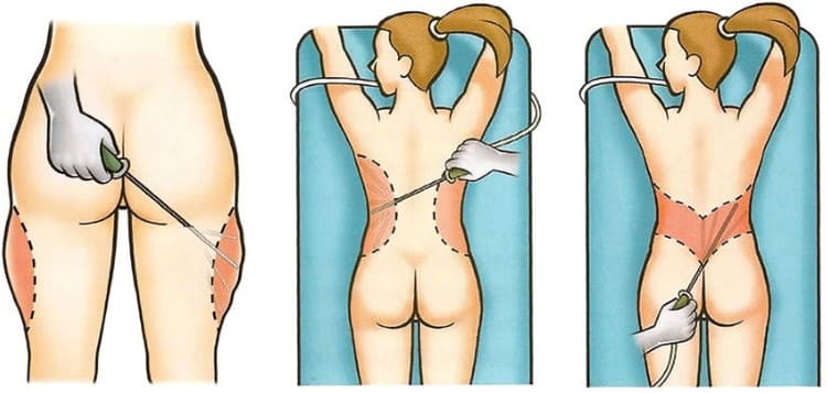 Zonas de lipoaspiración para hacer lipotransferencia
